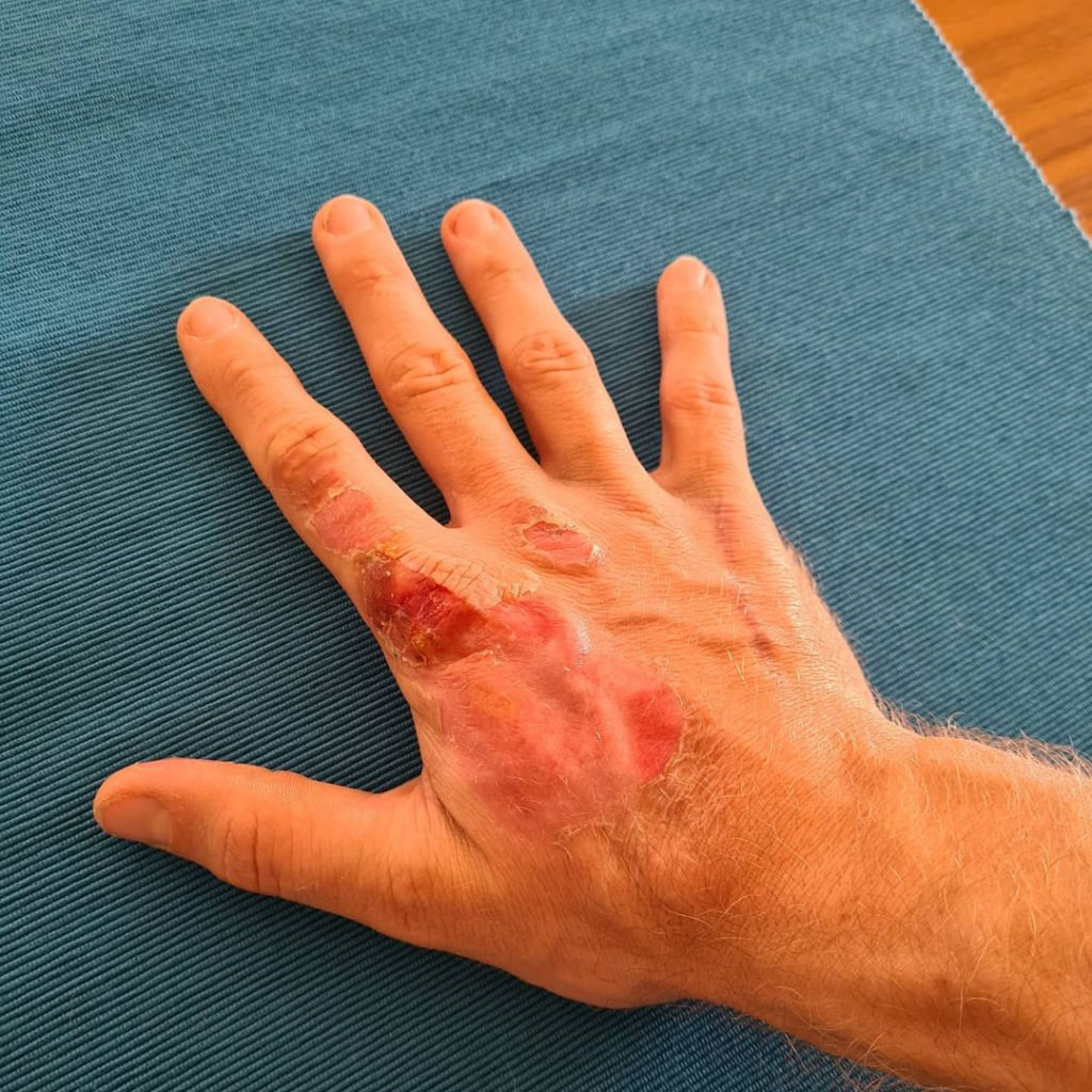 Grosjean shares photos of his healing right hand